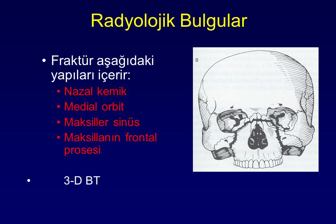 Radyolojik Bulgular Fraktür aşağıdaki yapıları içerir: Nazal kemik