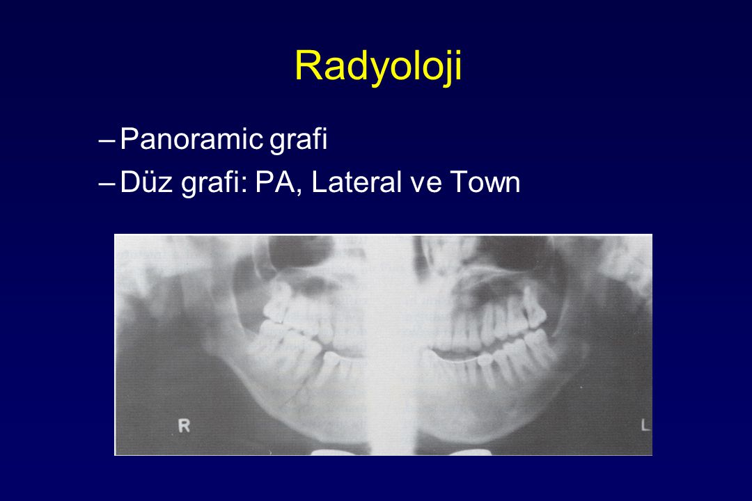 Radyoloji Panoramic grafi Düz grafi: PA, Lateral ve Town