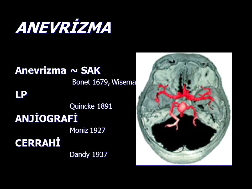 Аневризма галена