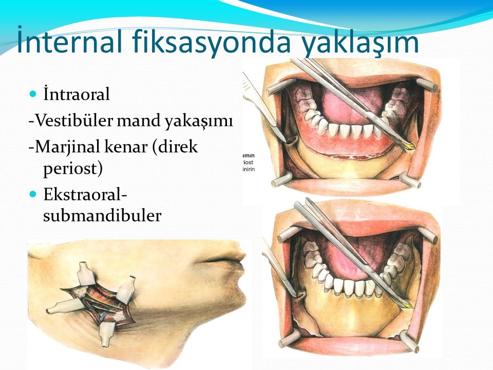 Spontaneous Internal Ouchies